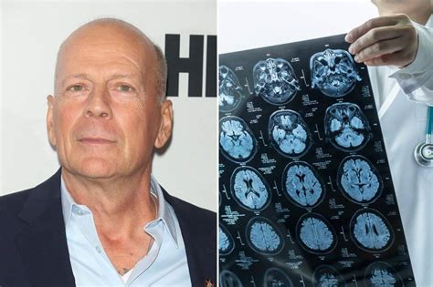 where does bruce willis have brain damage